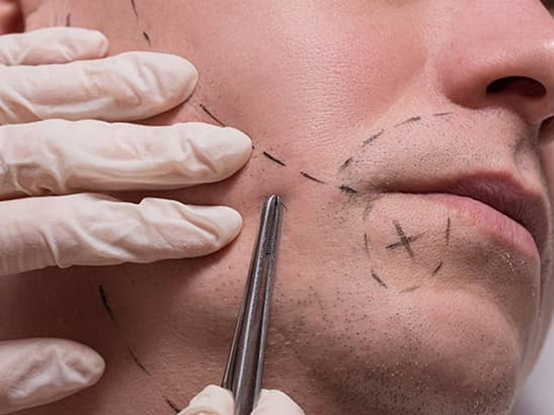 Best Beard Transplant in Ashok Nagar Chennai